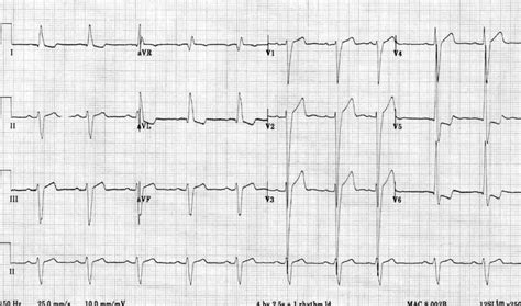 lv high voltage|severe lvh left bundle.